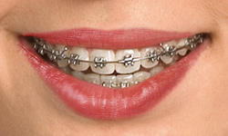 Types of Braces, Statler Orthodontics