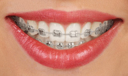 Braces - Danville VA Eden NC Orthodontist